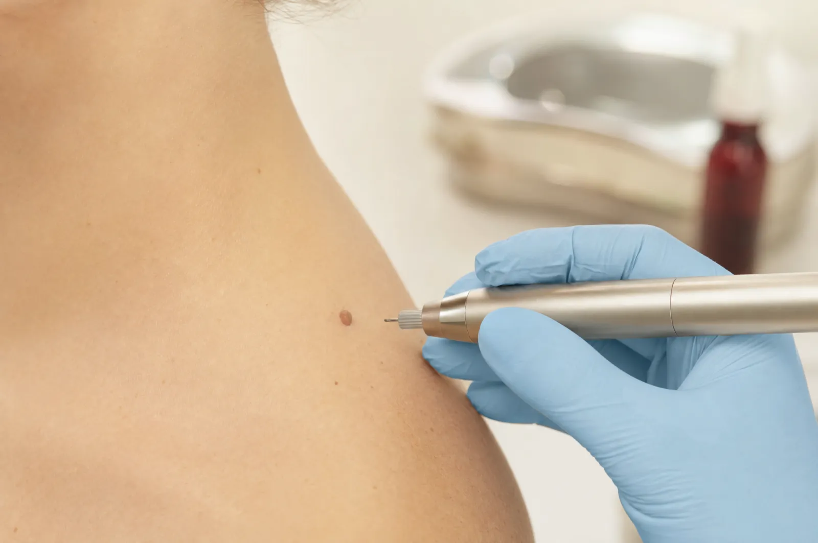 Close, careful skin assessment before a minor skin-lesion removal at the clinic.